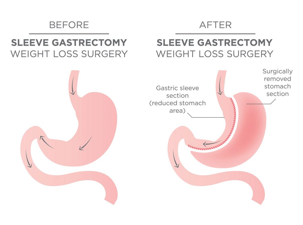 Before and After Gastric Sleeve Weight Loss Surgery